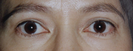 Après Blépharoplastie oeil asiatique