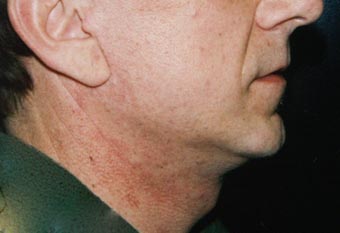 Après Lifting cervico facial