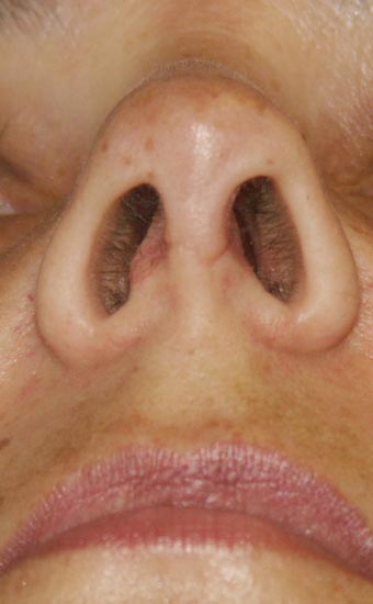 Après Rhinoplastie