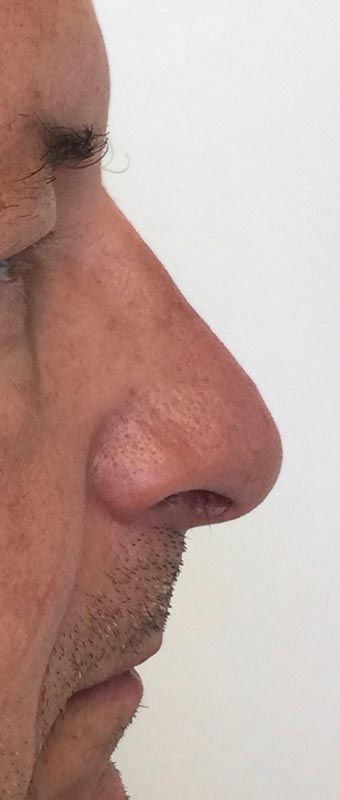 Après Rhinoplastie