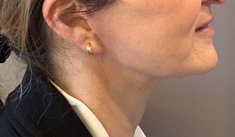 Après lifting cervico facial