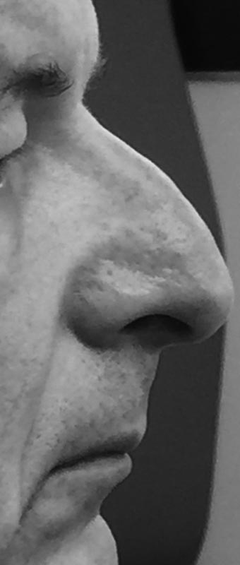 Avant Rhinoplastie