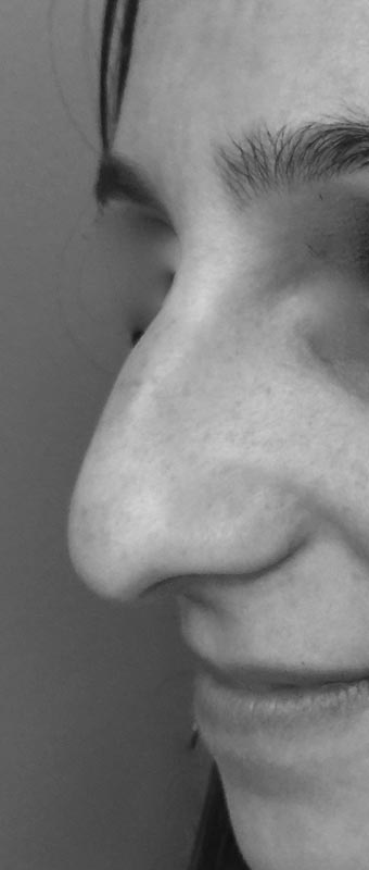 Avant Rhinoplastie