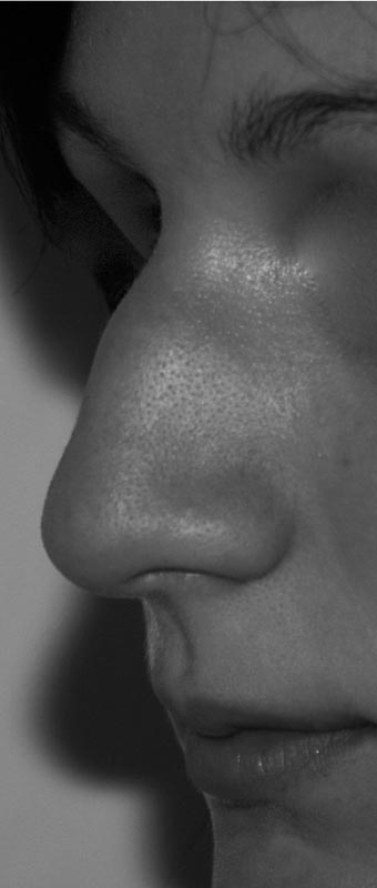 Avant Rhinoplastie