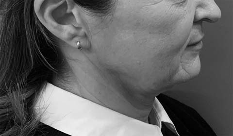 Avant lifting cervico facial